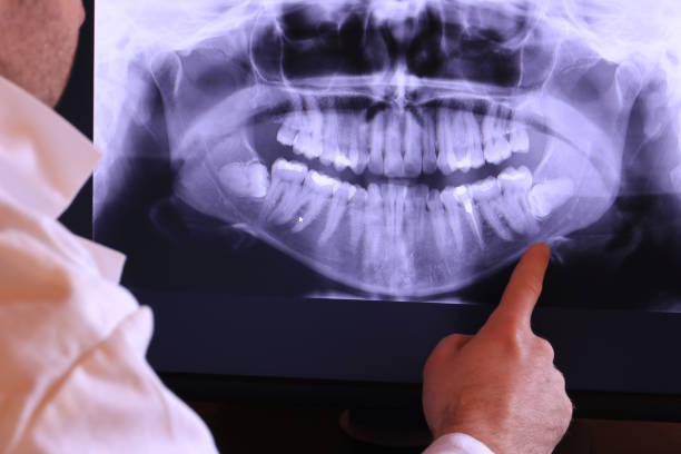 Best Emergency Wisdom Tooth Extraction in South Boston, VA